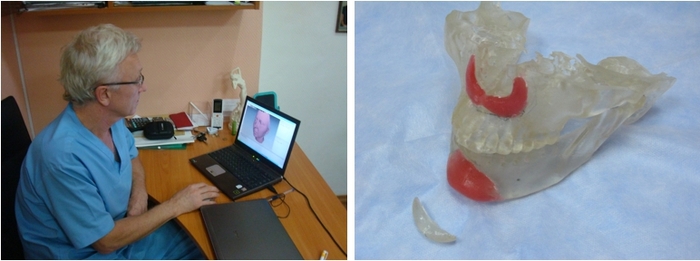 手持式3D掃描-顎骨矯正應用